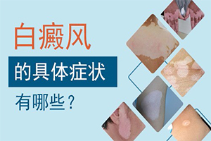 10岁儿童怎样预防白癜风（预防白癜风的方法）